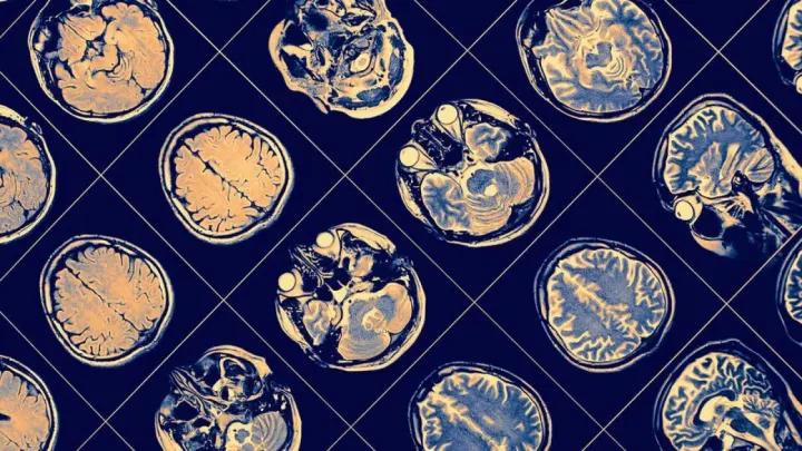 Alzheimer Tanısında Kan Testi Dönemi: p-tau217 Testi Nedir, Kimlere Yapılır?