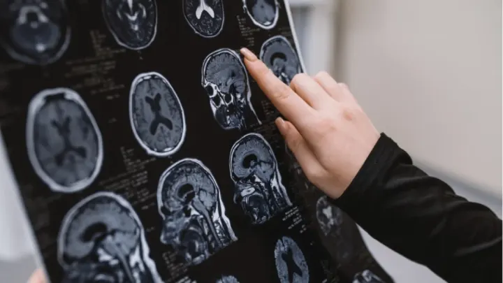 Alzheimer Hastalarının Büyük Bölümü Kadınlardan Oluşuyor
