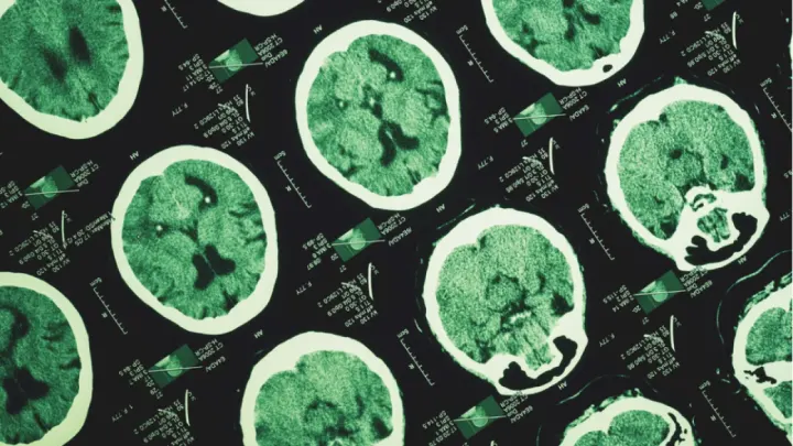 Alzheimer Belirtileri Yıllar Önce Başlayabilir: Erken Tanıda Yeni Dönem