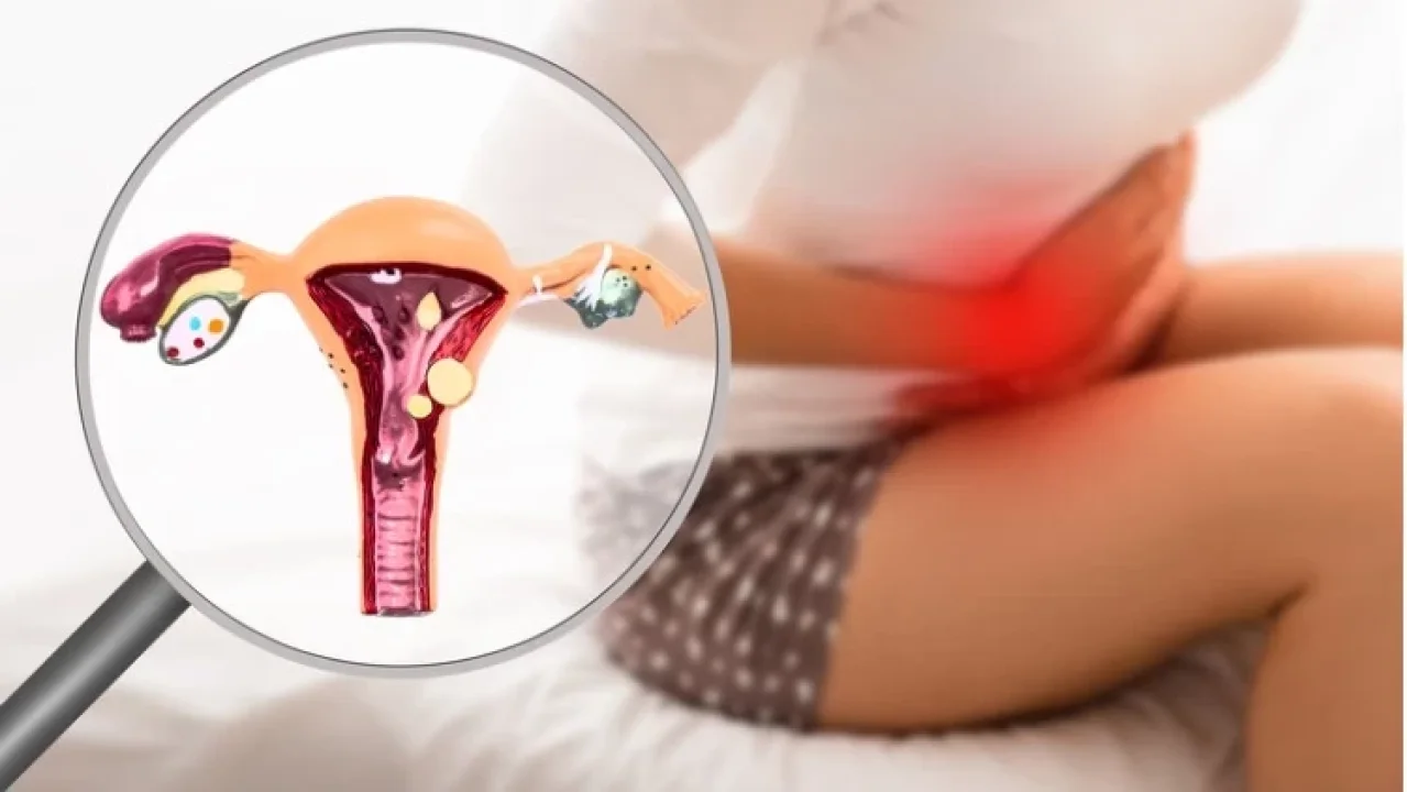 Endometriozis Birçok Sağlık Sorununa Neden Olabiliyor