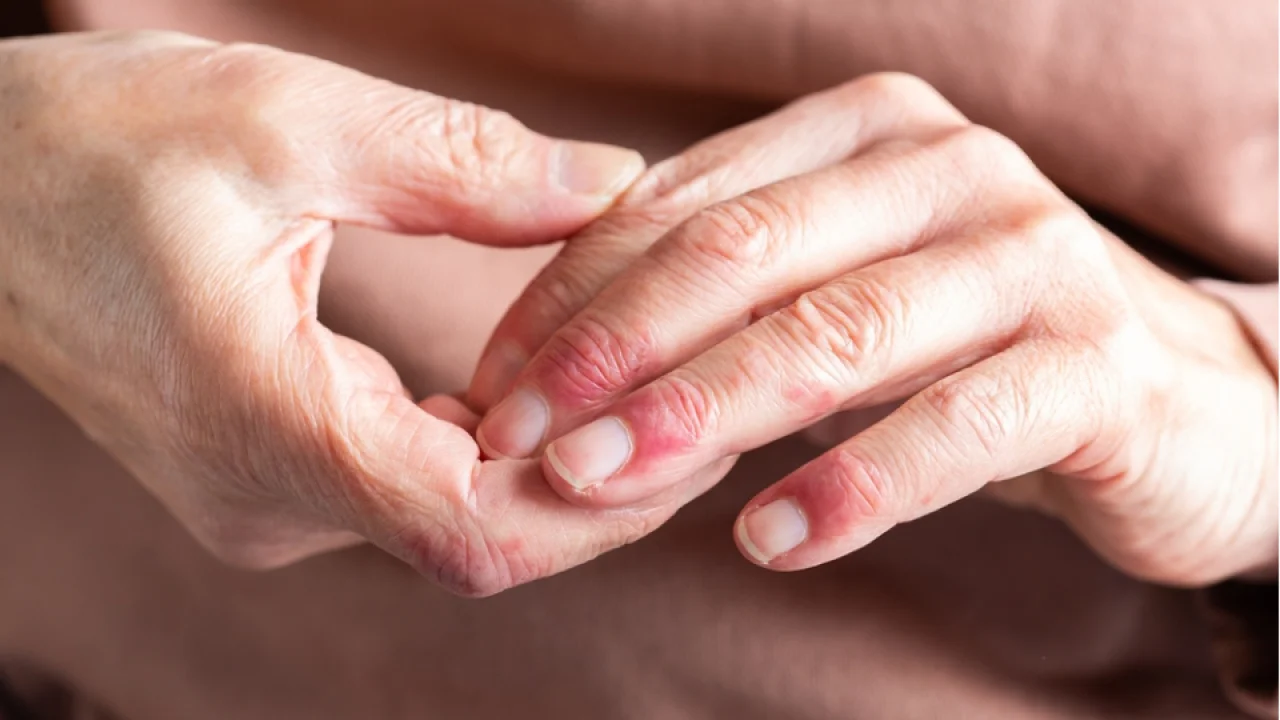 Atopik Dermatitin Görünmeyen Etkileri Sanatla Anlatıldı